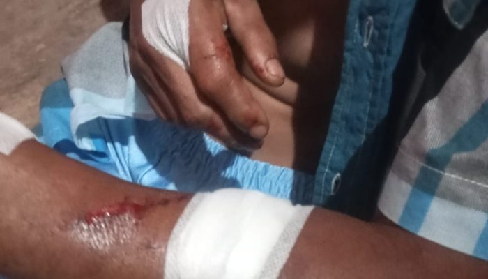 Cari Ketam, Warga Tanjungpinang Malah Digigit Buaya Hingga 24 Jahitan!